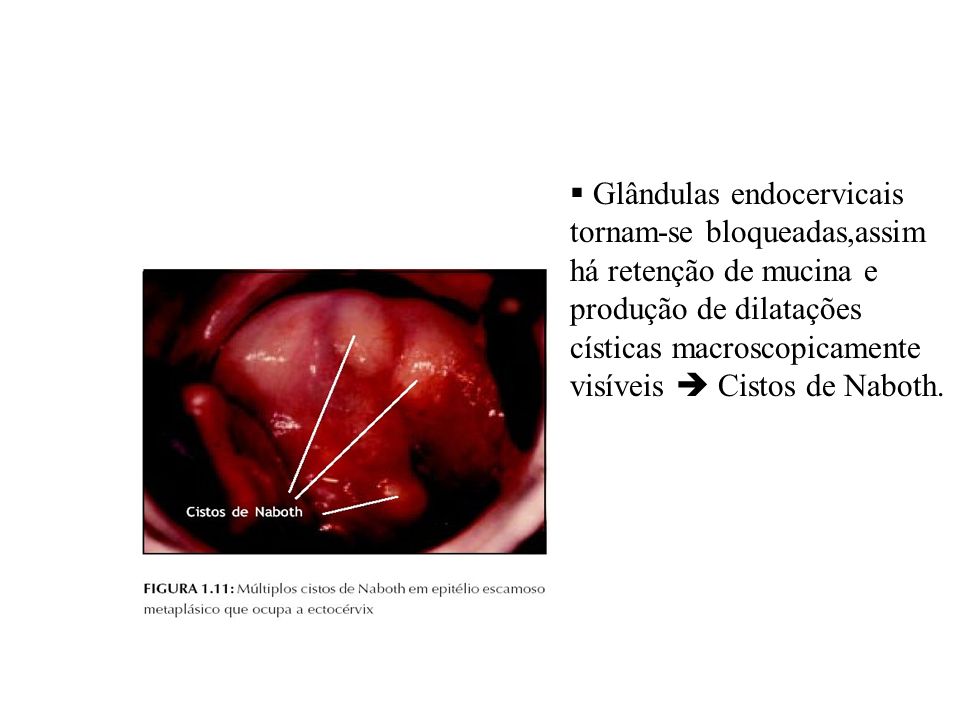 Glândulas endocervicais tornam-se bloqueadas,assim há retenção de mucina e produção de dilatações císticas macroscopicamente visíveis  Cistos de Naboth.