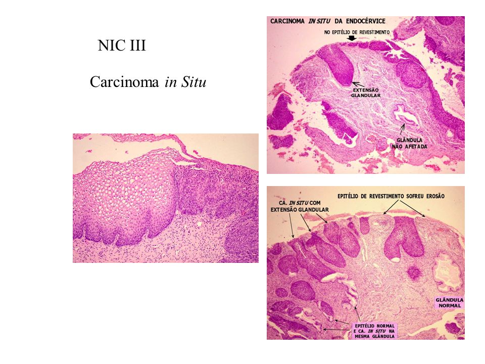 NIC III Carcinoma in Situ
