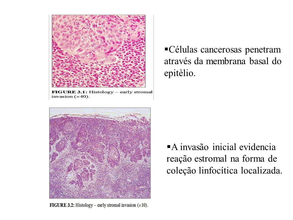 Células cancerosas penetram através da membrana basal do epitèlio.