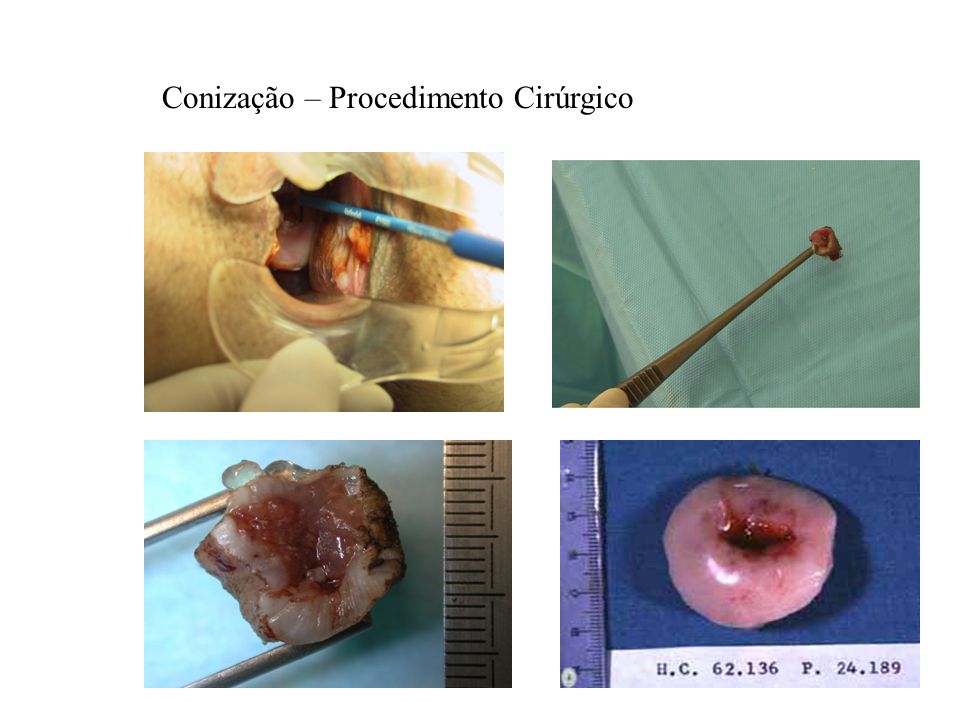 Conização – Procedimento Cirúrgico