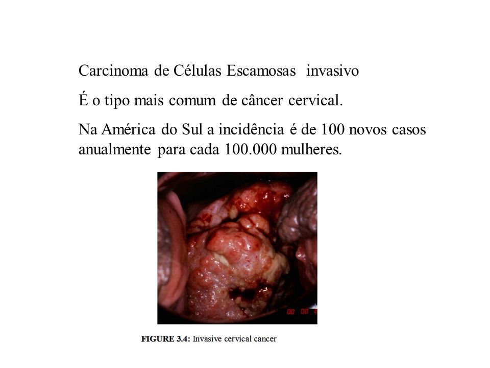 Carcinoma de Células Escamosas invasivo