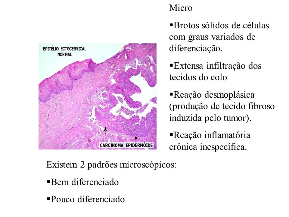 Micro Brotos sólidos de células com graus variados de diferenciação. Extensa infiltração dos tecidos do colo.