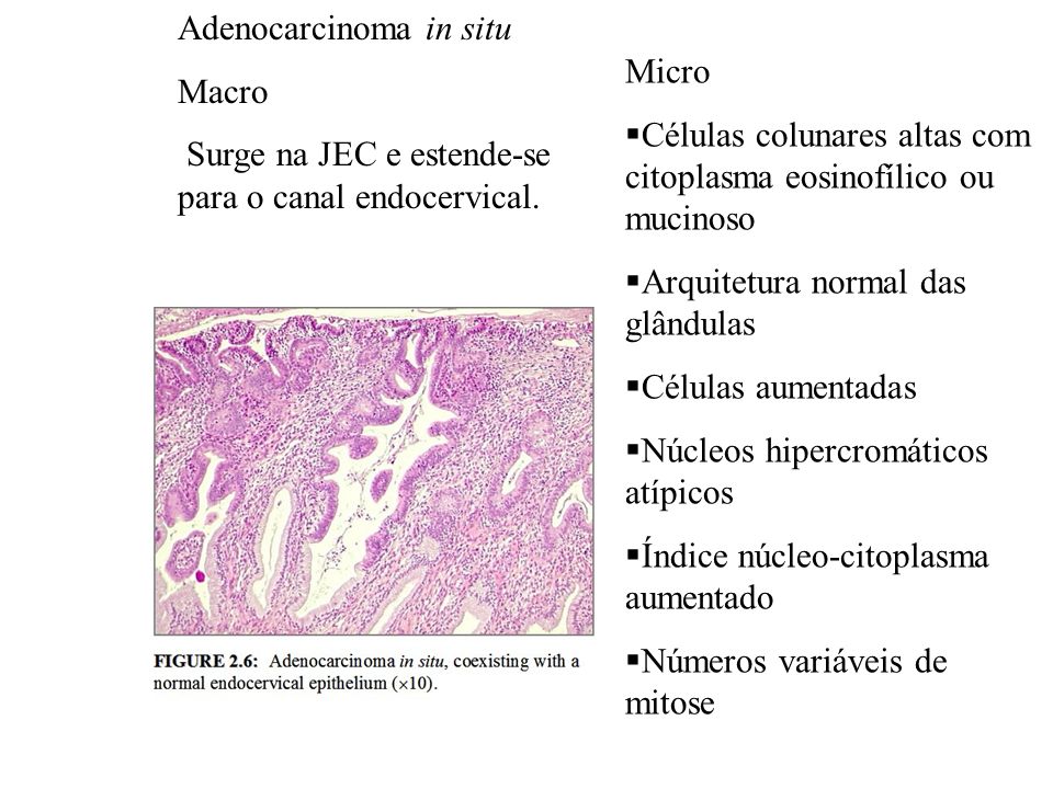 Adenocarcinoma in situ