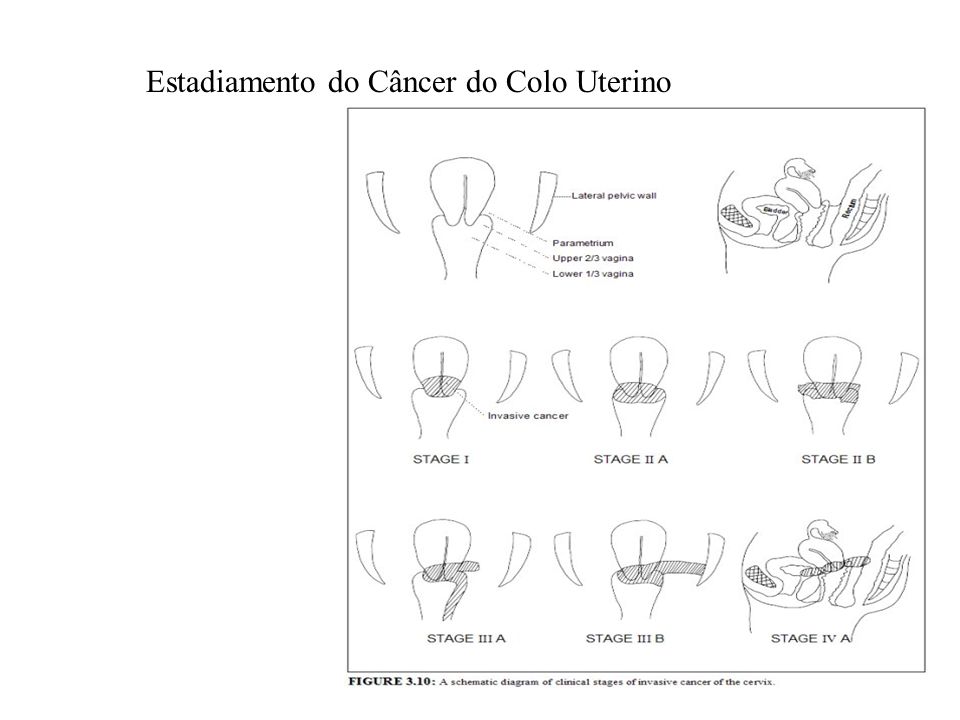 Estadiamento do Câncer do Colo Uterino