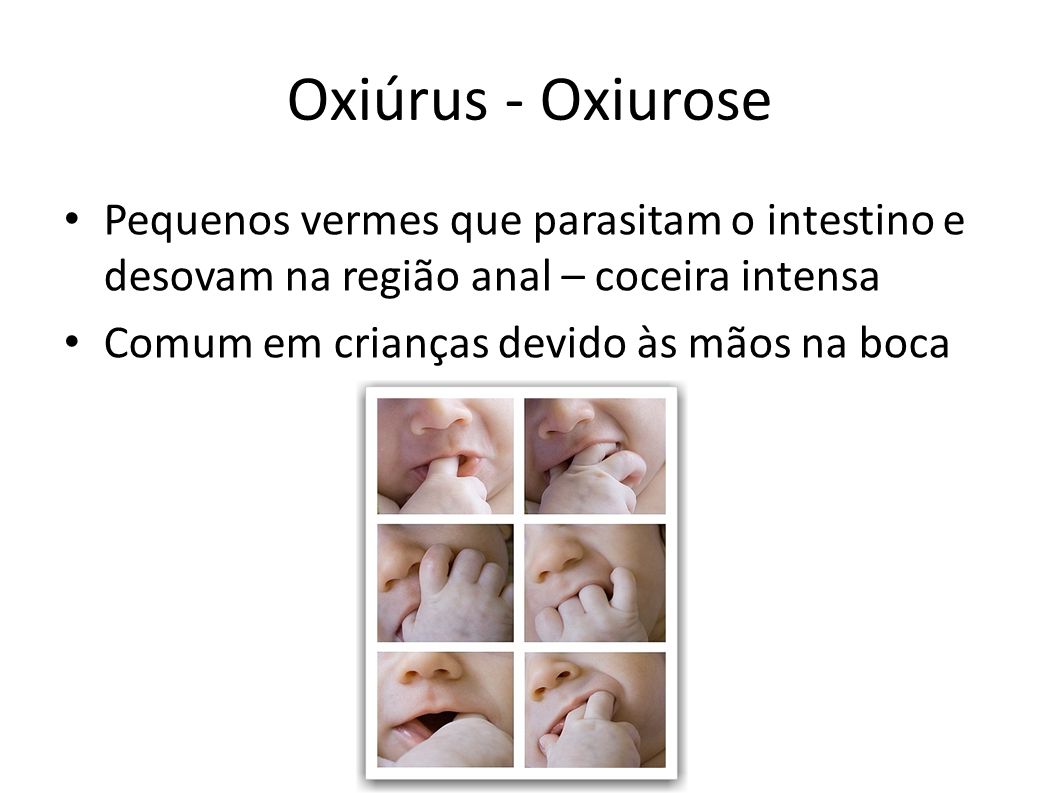 Oxiúrus - Oxiurose Pequenos vermes que parasitam o intestino e desovam na região anal – coceira intensa.
