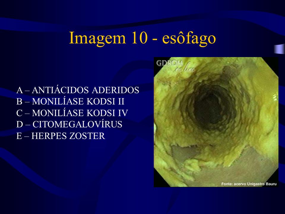 Imagem 10 - esôfago A – ANTIÁCIDOS ADERIDOS B – MONILÍASE KODSI II