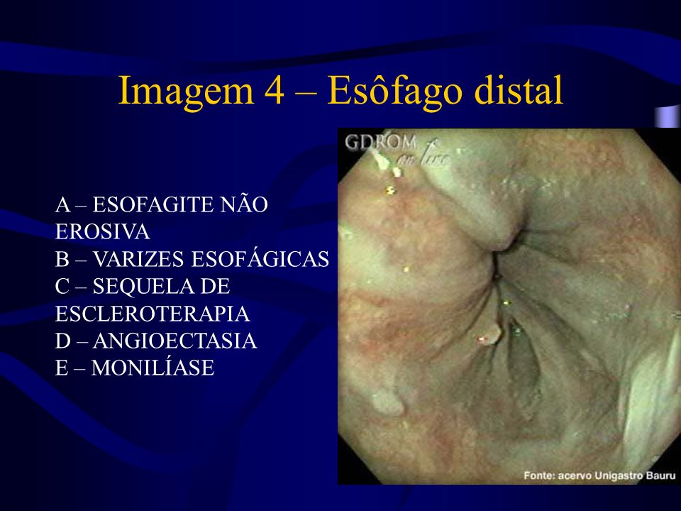 Imagem 4 – Esôfago distal