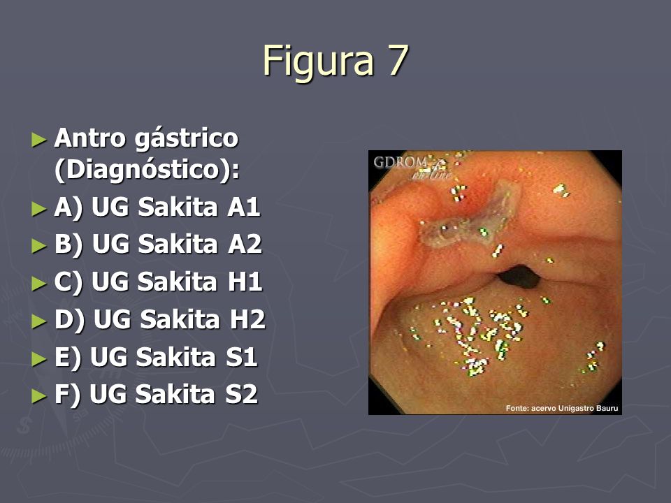 Figura 7 Antro gástrico (Diagnóstico): A) UG Sakita A1 B) UG Sakita A2