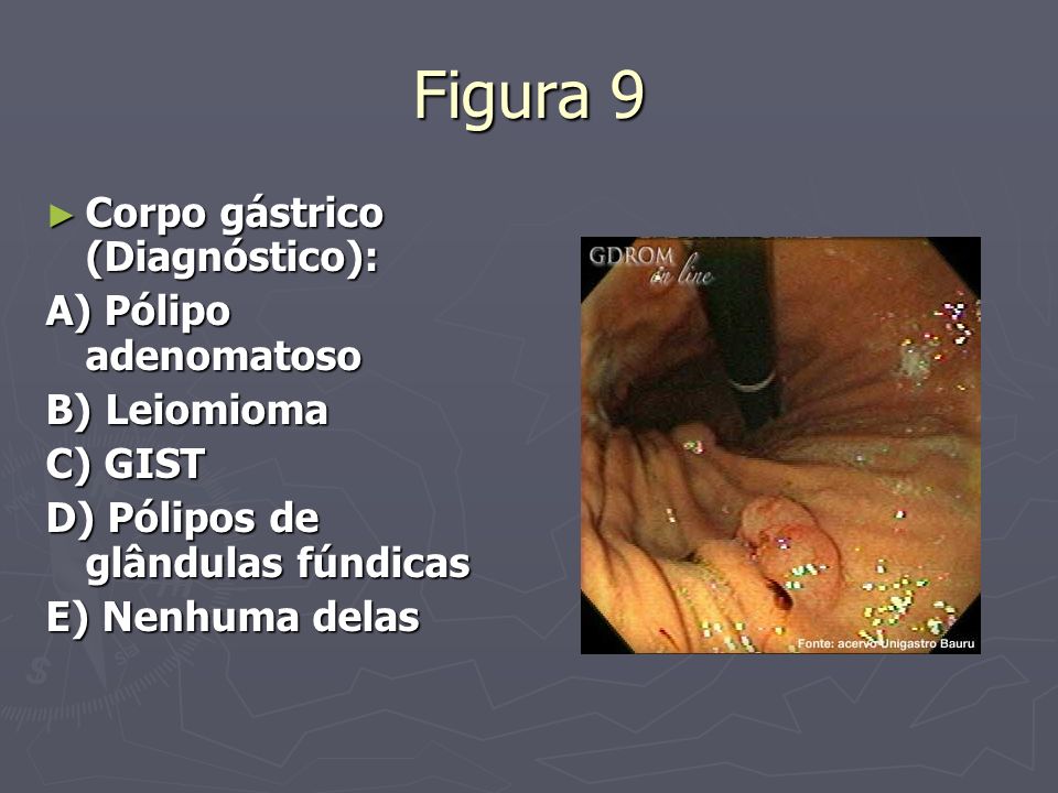 Figura 9 Corpo gástrico (Diagnóstico): A) Pólipo adenomatoso
