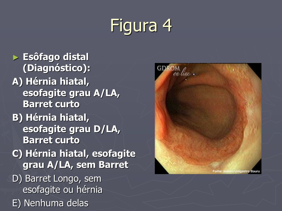 Figura 4 Esôfago distal (Diagnóstico):