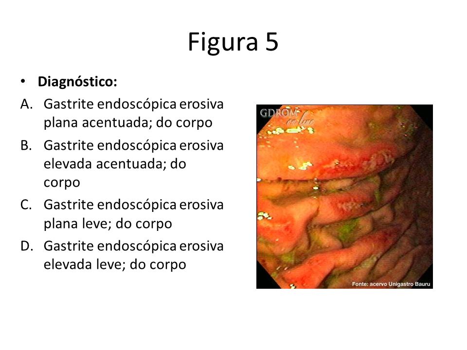 Figura 5 Diagnóstico: Gastrite endoscópica erosiva plana acentuada; do corpo. Gastrite endoscópica erosiva elevada acentuada; do corpo.