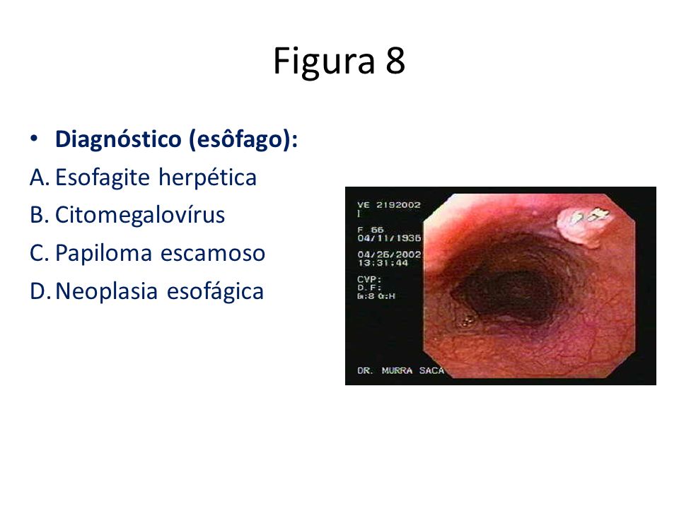Figura 8 Diagnóstico (esôfago): Esofagite herpética Citomegalovírus