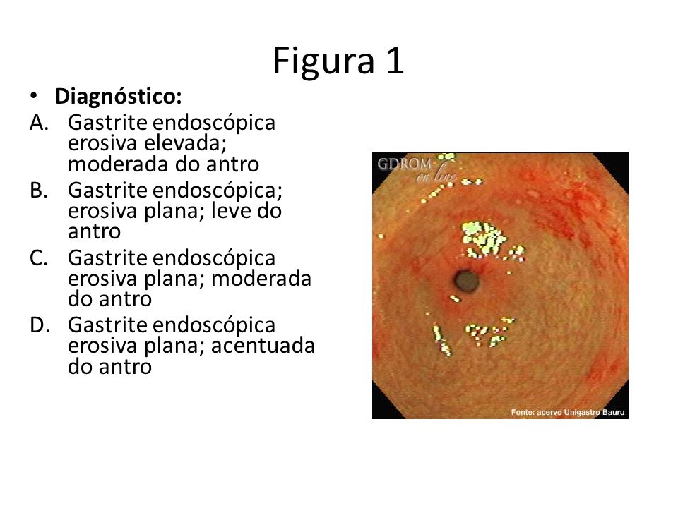 Figura 1 Diagnóstico: Gastrite endoscópica erosiva elevada; moderada do antro. Gastrite endoscópica; erosiva plana; leve do antro.