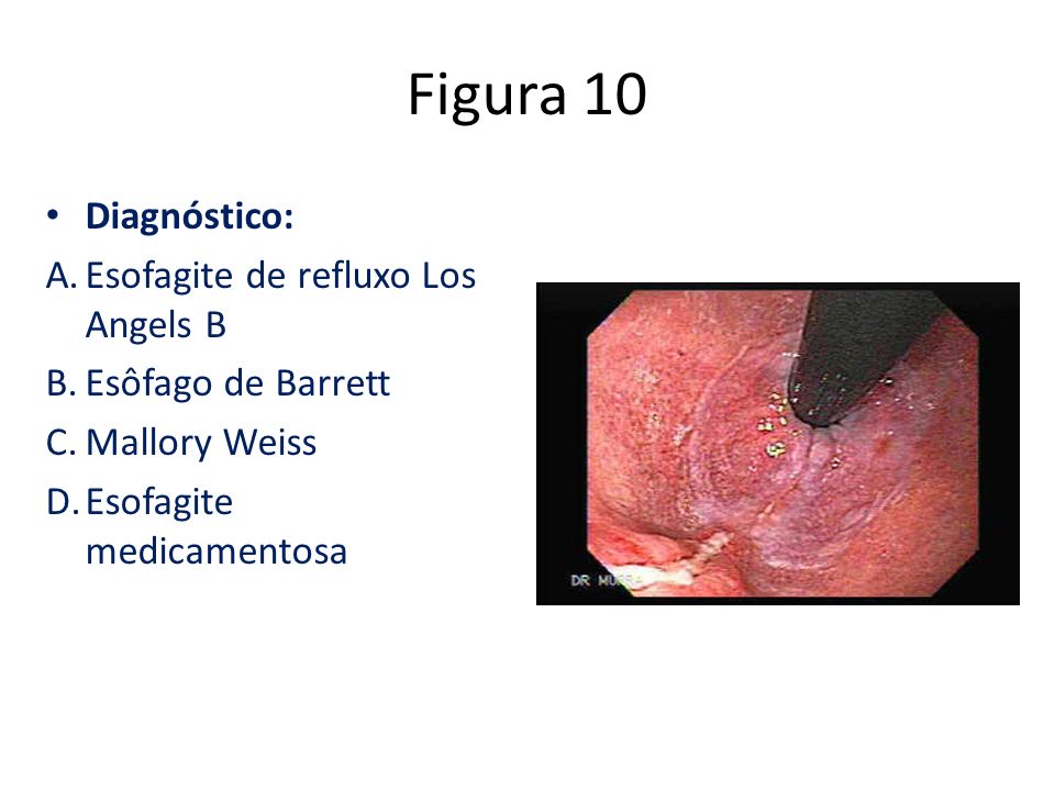 Figura 10 Diagnóstico: Esofagite de refluxo Los Angels B