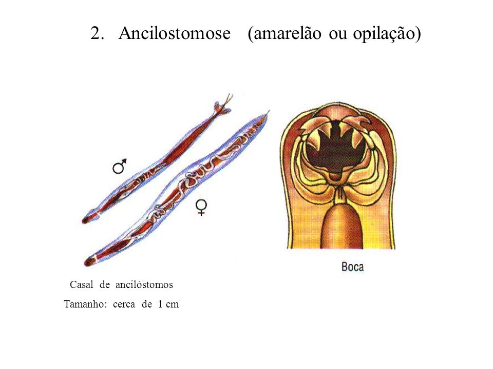 2. Ancilostomose (amarelão ou opilação)