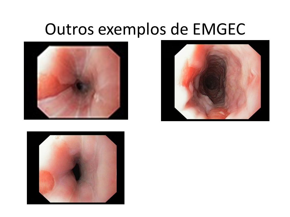 Outros exemplos de EMGEC
