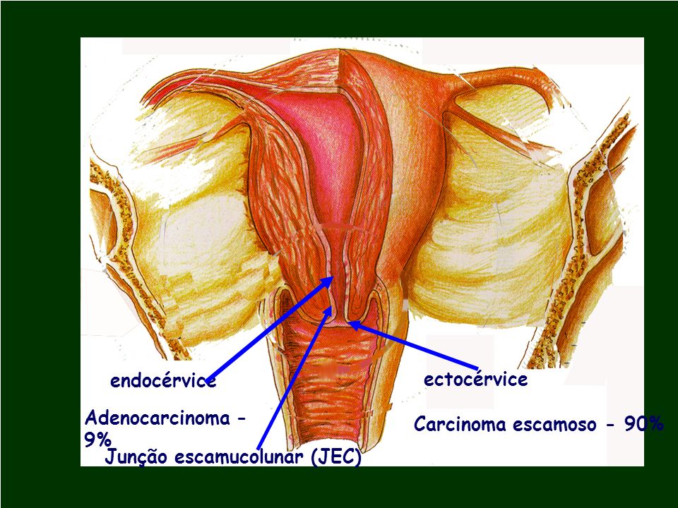 endocérvice ectocérvice Adenocarcinoma - 9% Carcinoma escamoso - 90% Junção escamucolunar (JEC)