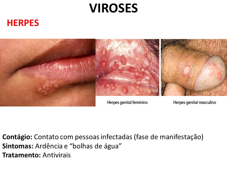 VIROSES HERPES. Contágio: Contato com pessoas infectadas (fase de manifestação) Sintomas: Ardência e bolhas de água