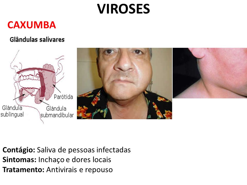 VIROSES CAXUMBA Contágio: Saliva de pessoas infectadas