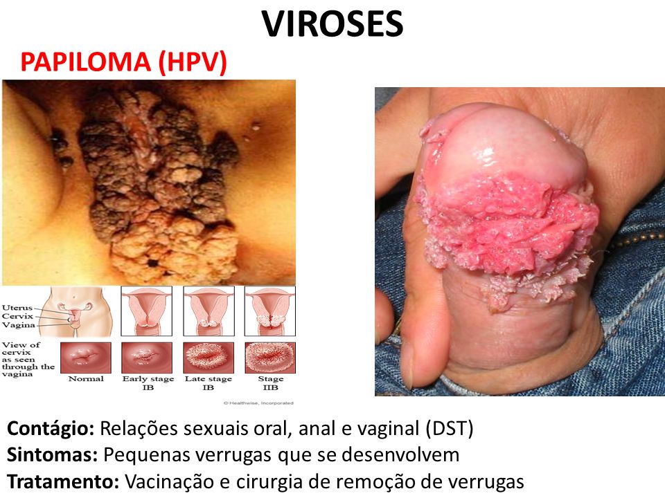 VIROSES PAPILOMA (HPV)