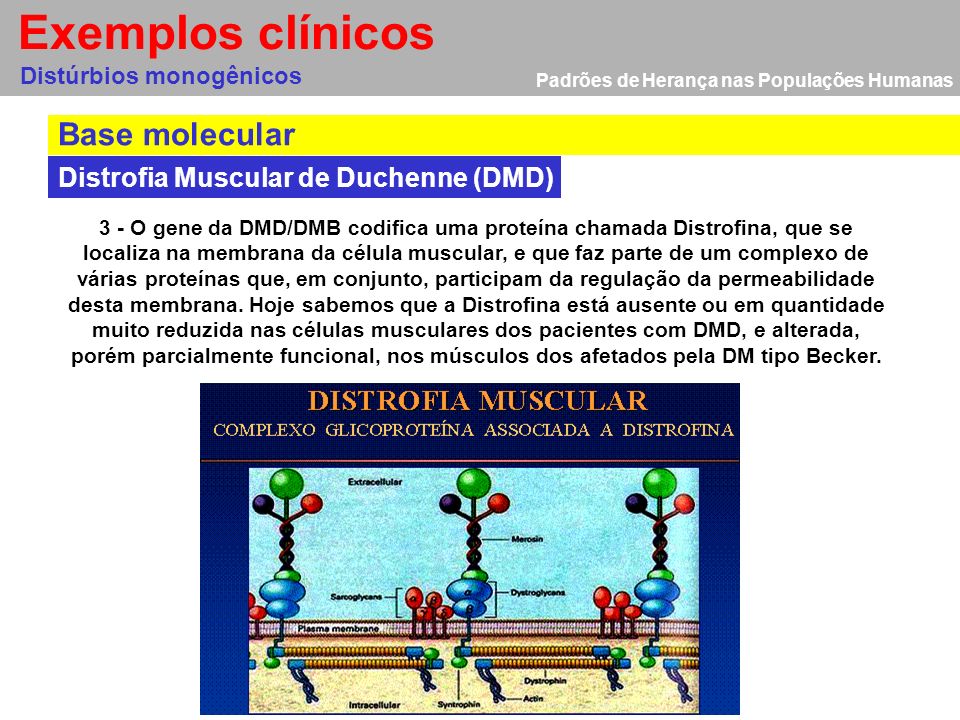 Exemplos clínicos Base molecular Distrofia Muscular de Duchenne (DMD)