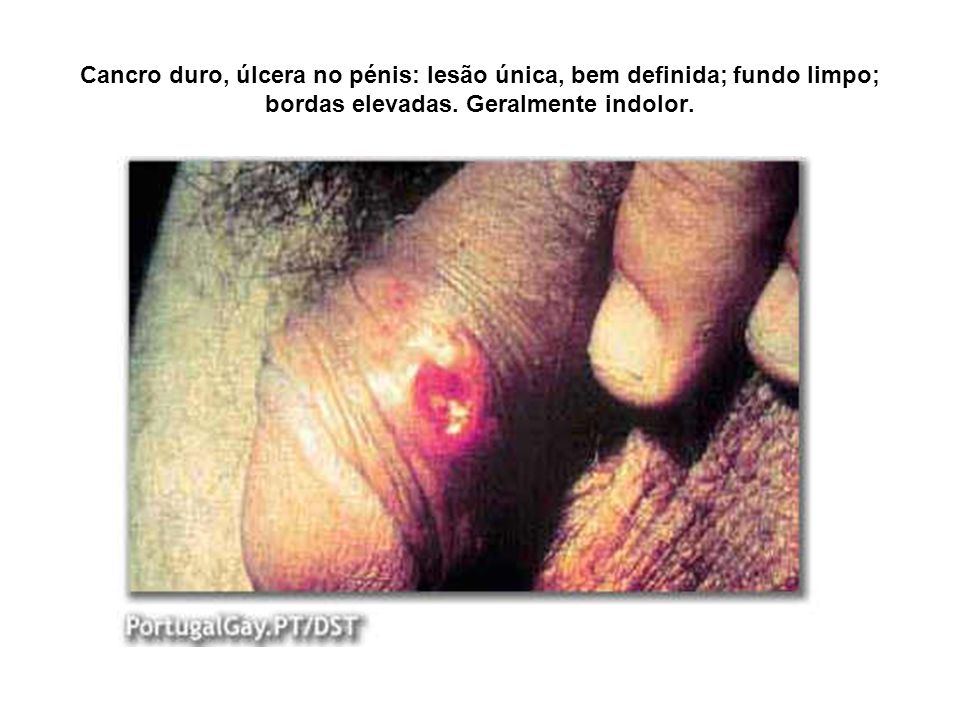 Cancro duro, úlcera no pénis: lesão única, bem definida; fundo limpo; bordas elevadas.