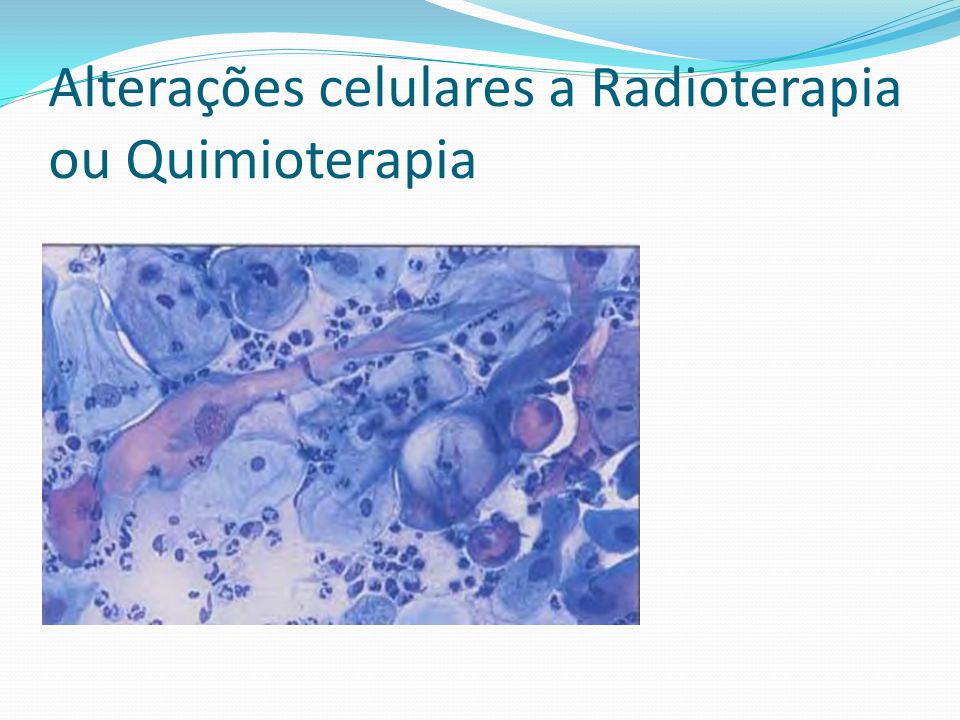 Alterações celulares a Radioterapia ou Quimioterapia
