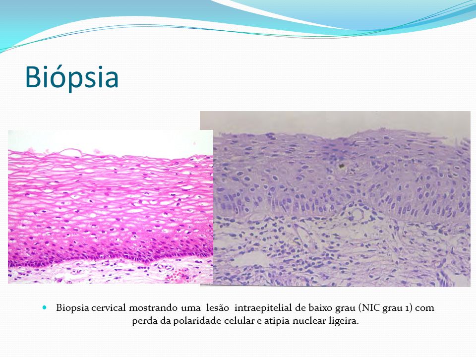 Biópsia Biopsia cervical mostrando uma lesão intraepitelial de baixo grau (NIC grau 1) com perda da polaridade celular e atipia nuclear ligeira.