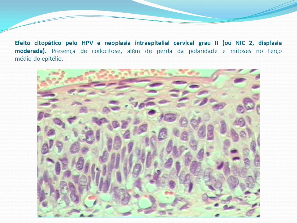 Efeito citopático pelo HPV e neoplasia intraepitelial cervical grau II (ou NIC 2, displasia moderada).
