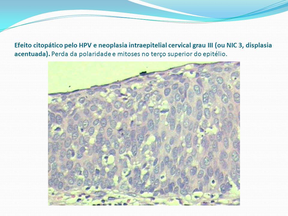 Efeito citopático pelo HPV e neoplasia intraepitelial cervical grau III (ou NIC 3, displasia acentuada).