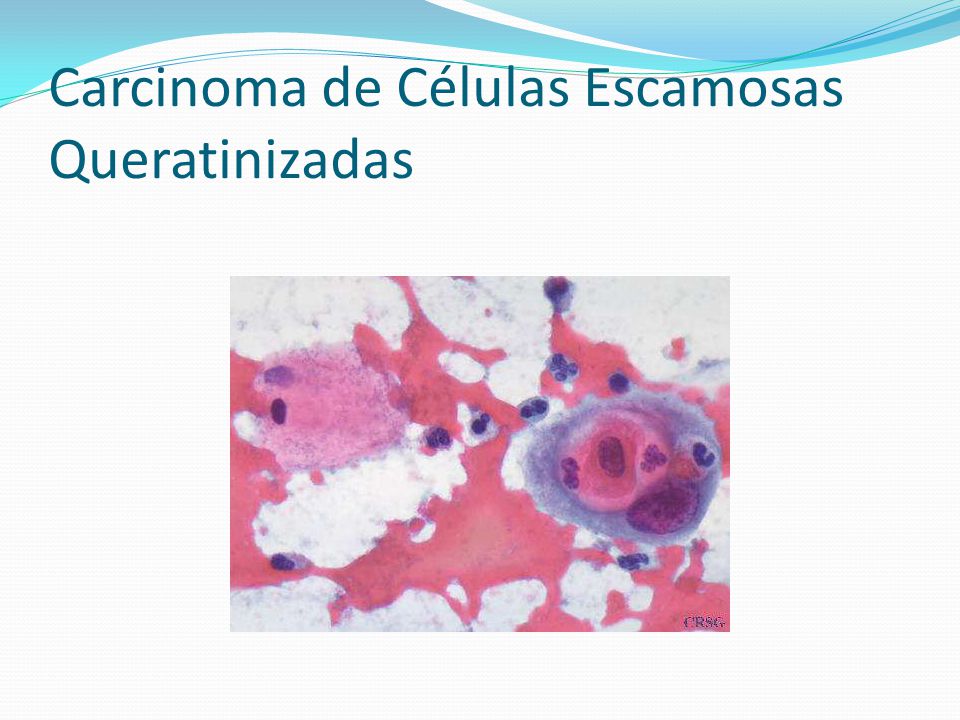 Carcinoma de Células Escamosas Queratinizadas