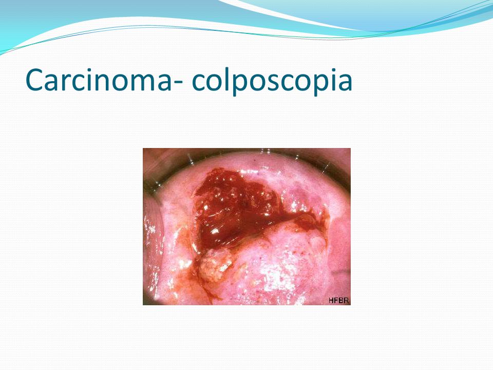 Carcinoma- colposcopia