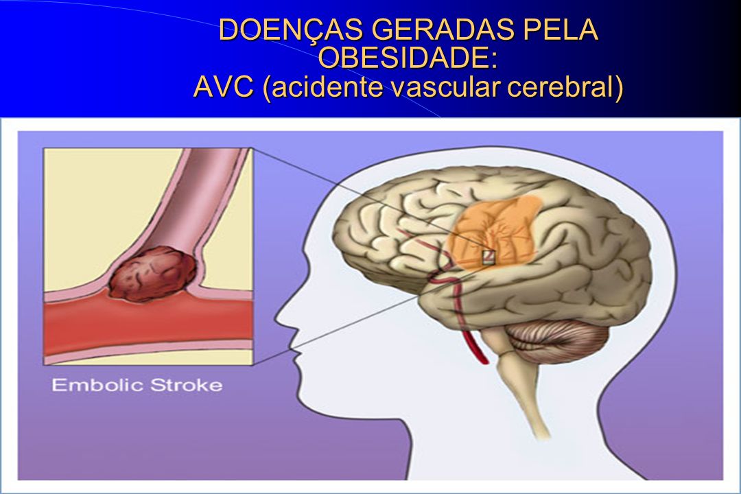 DOENÇAS GERADAS PELA OBESIDADE: AVC (acidente vascular cerebral)