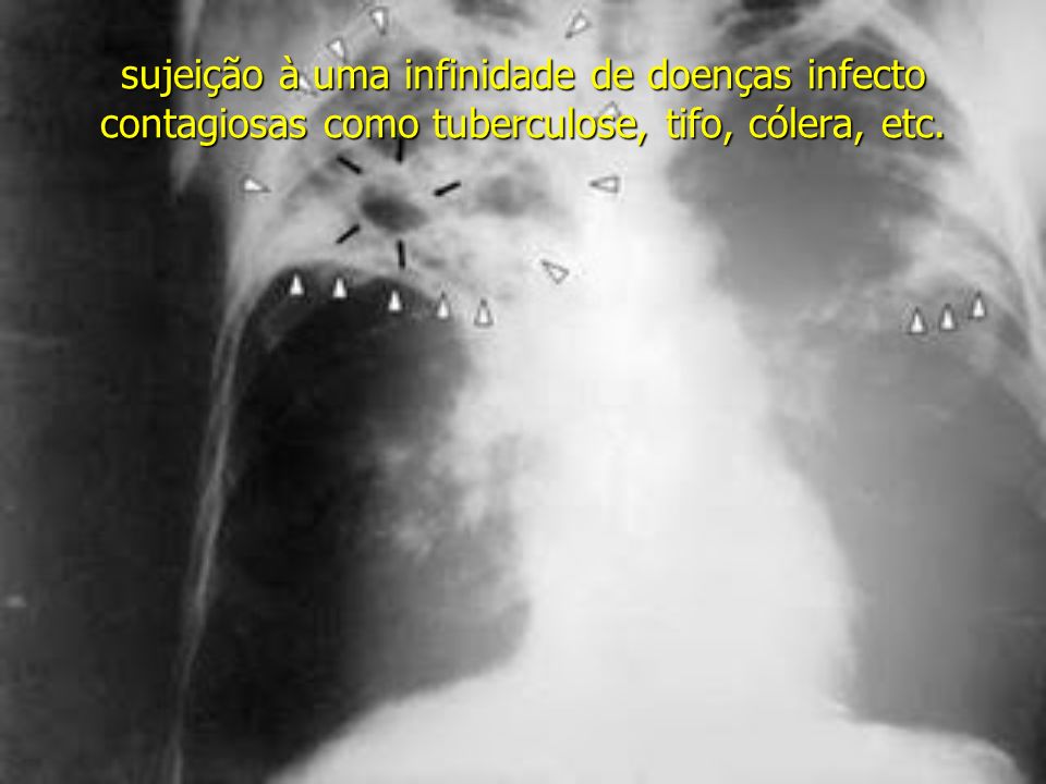 sujeição à uma infinidade de doenças infecto contagiosas como tuberculose, tifo, cólera, etc.