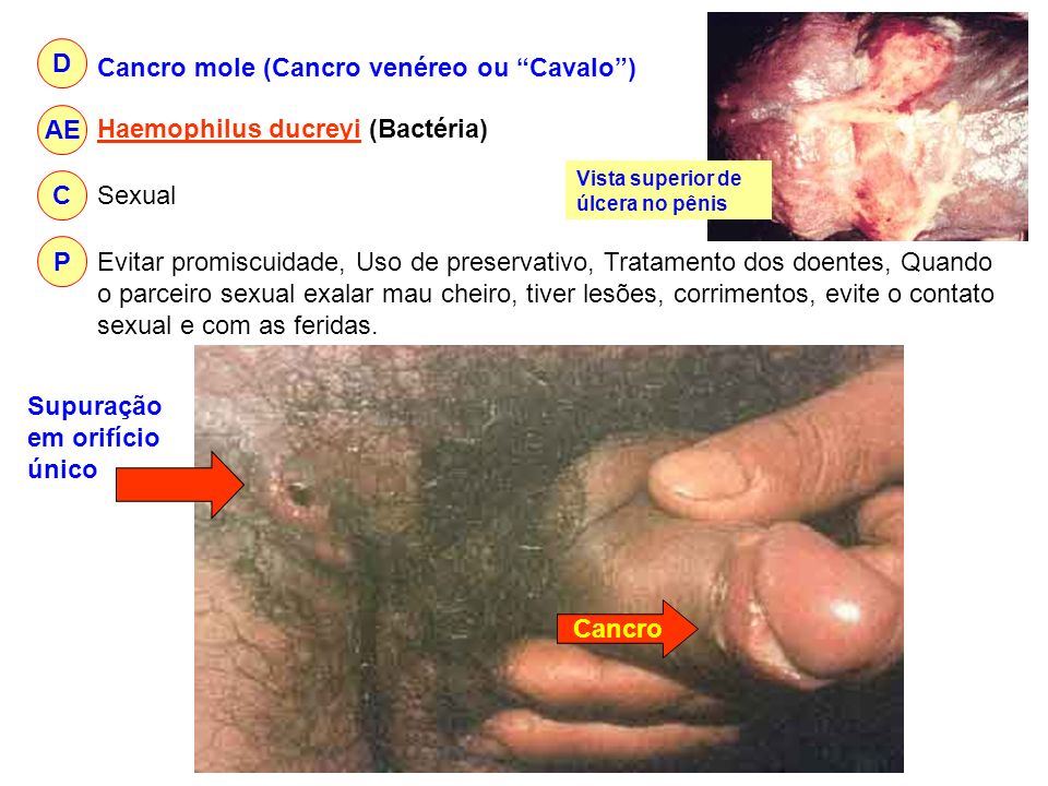Cancro mole (Cancro venéreo ou Cavalo )