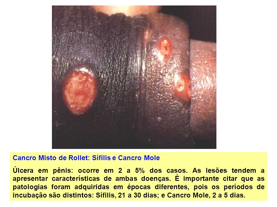 Cancro Misto de Rollet: Sífilis e Cancro Mole