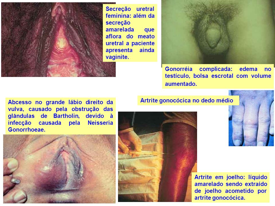 Secreção uretral feminina: além da secreção amarelada que aflora do meato uretral a paciente apresenta ainda vaginite.