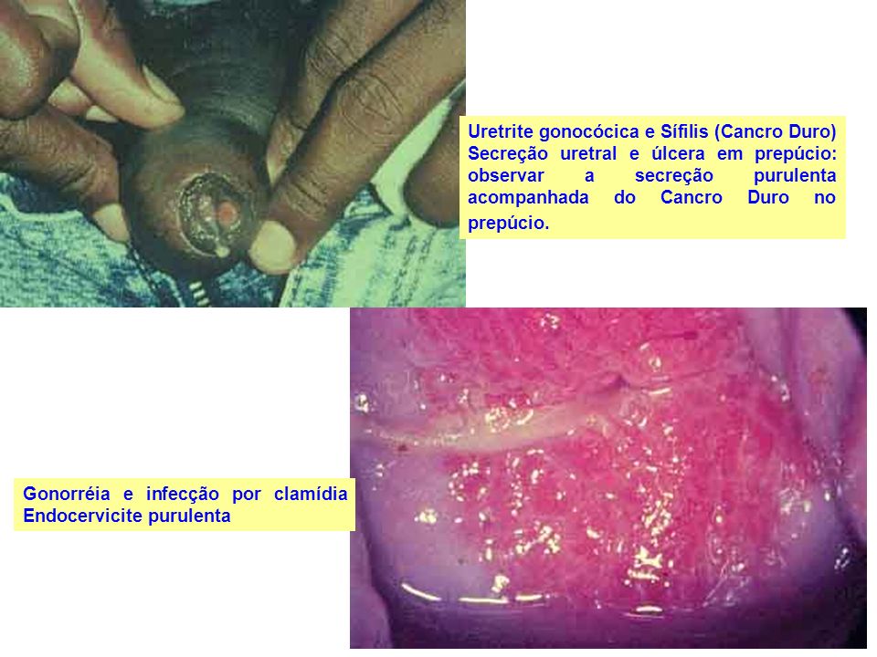 Uretrite gonocócica e Sífilis (Cancro Duro) Secreção uretral e úlcera em prepúcio: observar a secreção purulenta acompanhada do Cancro Duro no prepúcio.