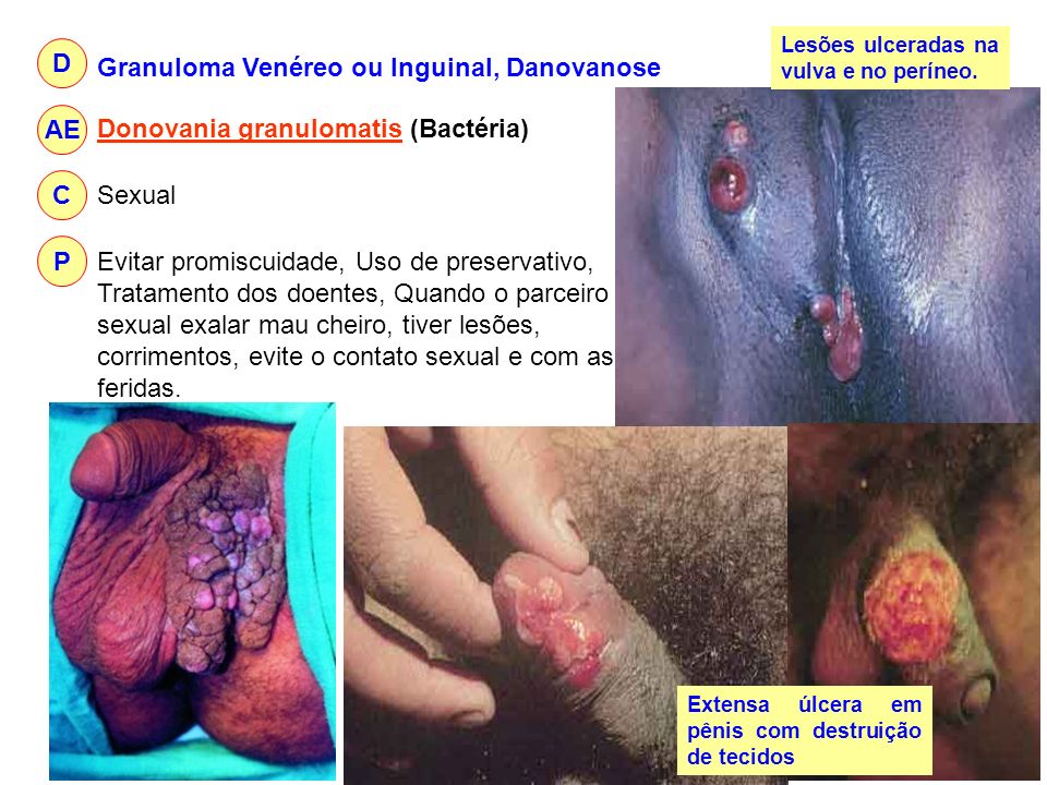 Granuloma Venéreo ou Inguinal, Danovanose