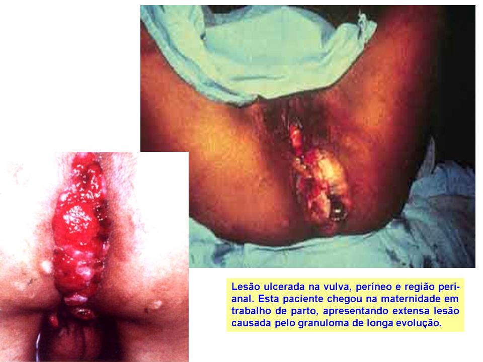 Lesão ulcerada na vulva, períneo e região peri-anal
