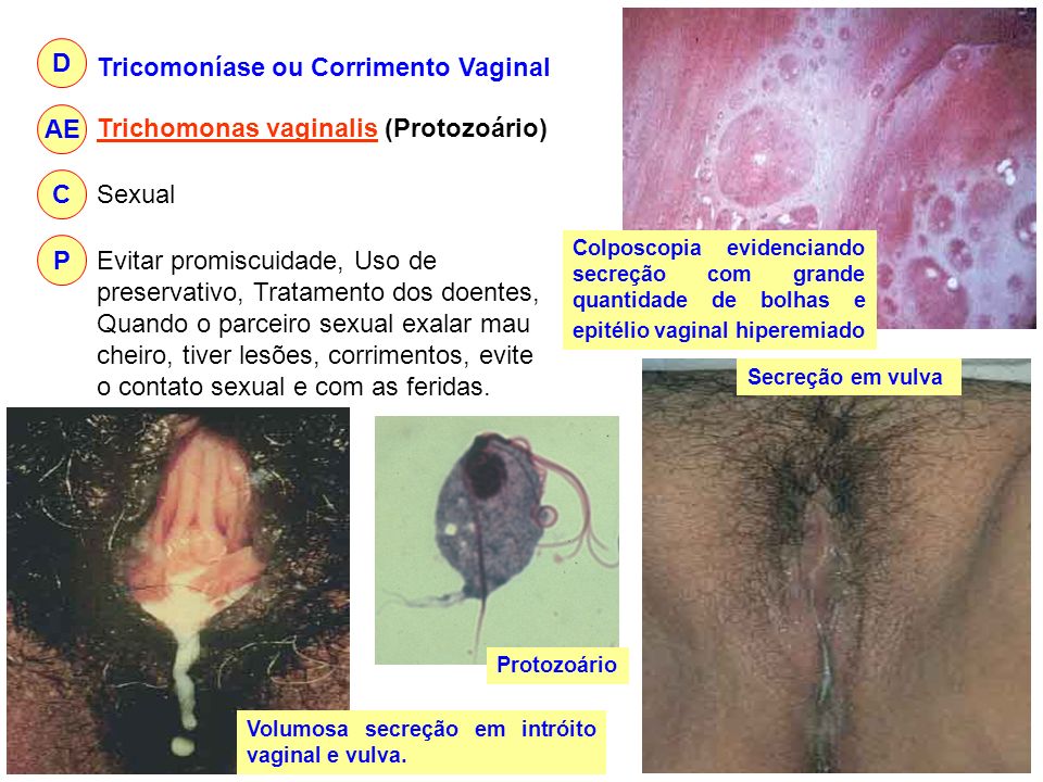 Tricomoníase ou Corrimento Vaginal