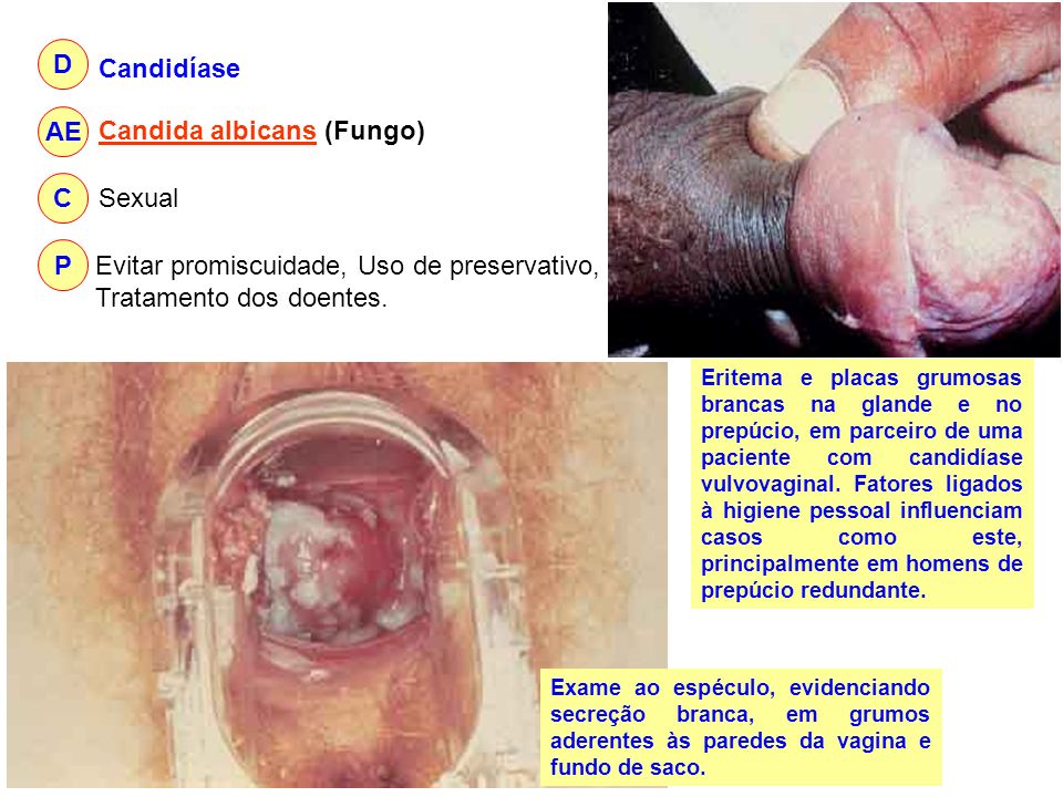 Candida albicans (Fungo)