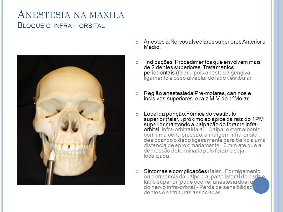 Anestesia na maxila Bloqueio infra - orbital
