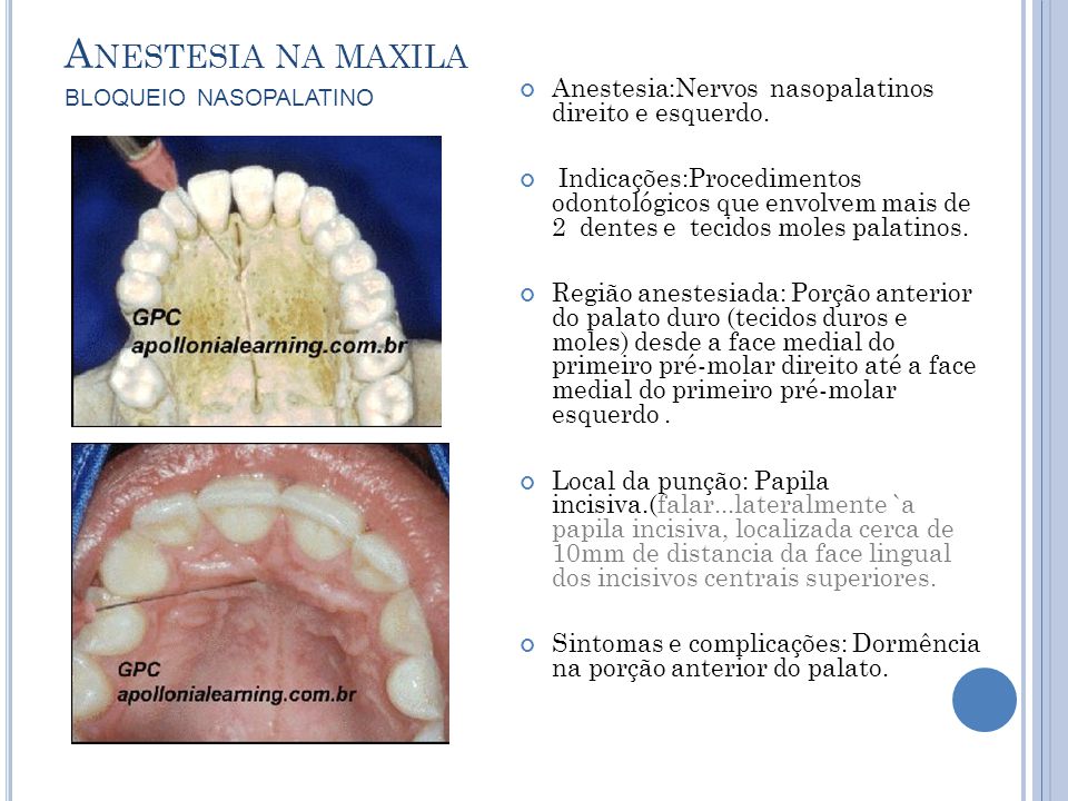 Anestesia na maxila bloqueio nasopalatino
