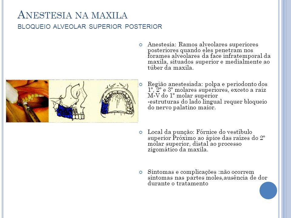 Anestesia na maxila bloqueio alveolar superior posterior
