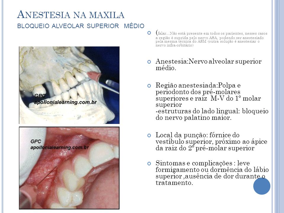 Anestesia na maxila bloqueio alveolar superior médio