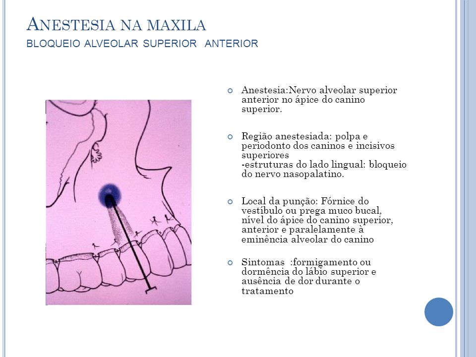 Anestesia na maxila bloqueio alveolar superior anterior