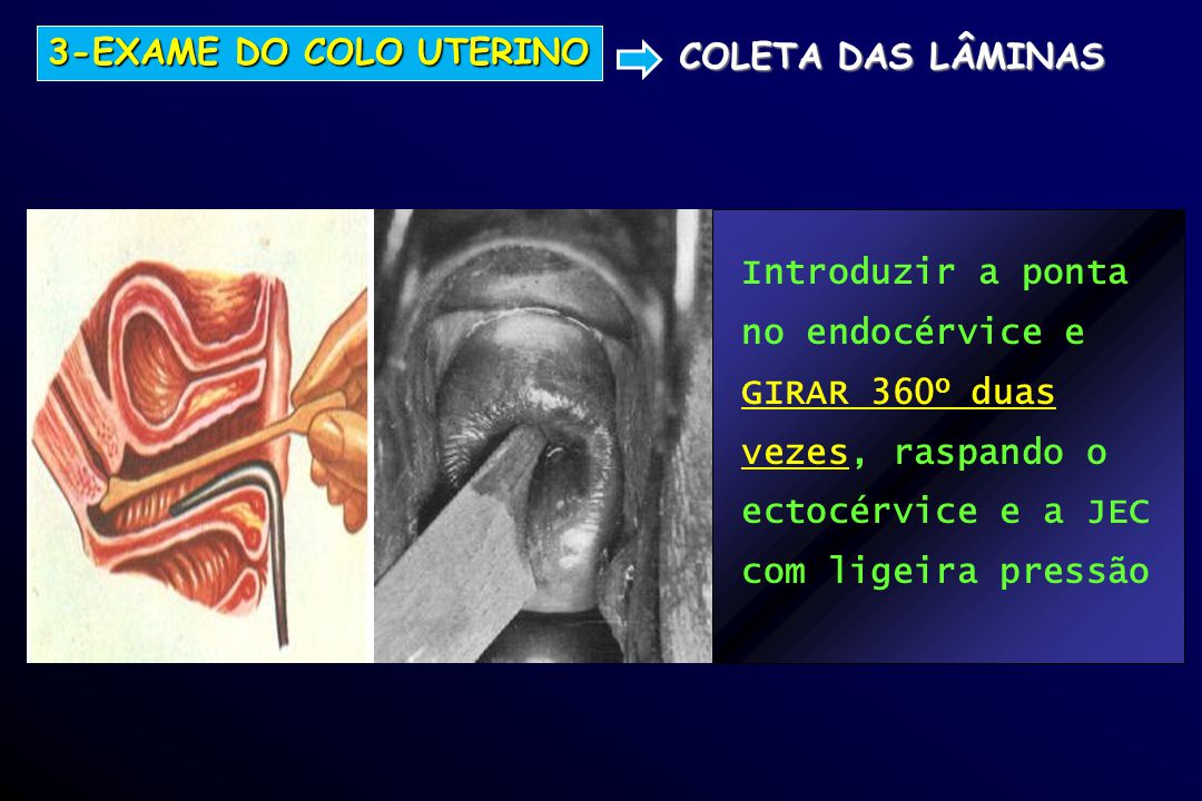 3-EXAME DO COLO UTERINO COLETA DAS LÂMINAS. Introduzir a ponta. no endocérvice e. GIRAR 360O duas.
