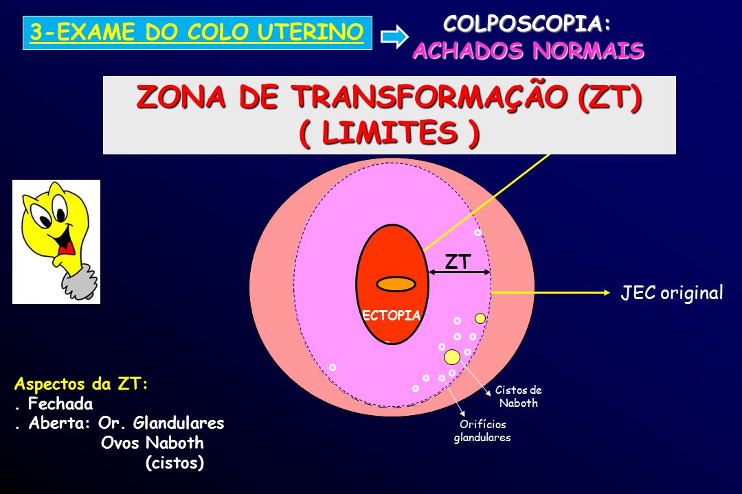 COLPOSCOPIA: ACHADOS NORMAIS ZONA DE TRANSFORMAÇÃO (ZT)