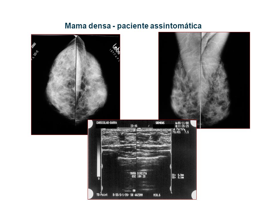 Mama densa - paciente assintomática